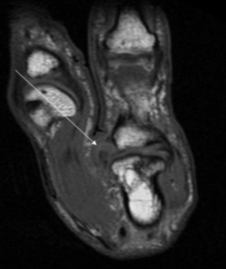 <p>Describe the pathology indicated by the arrow (Sag PD).</p>