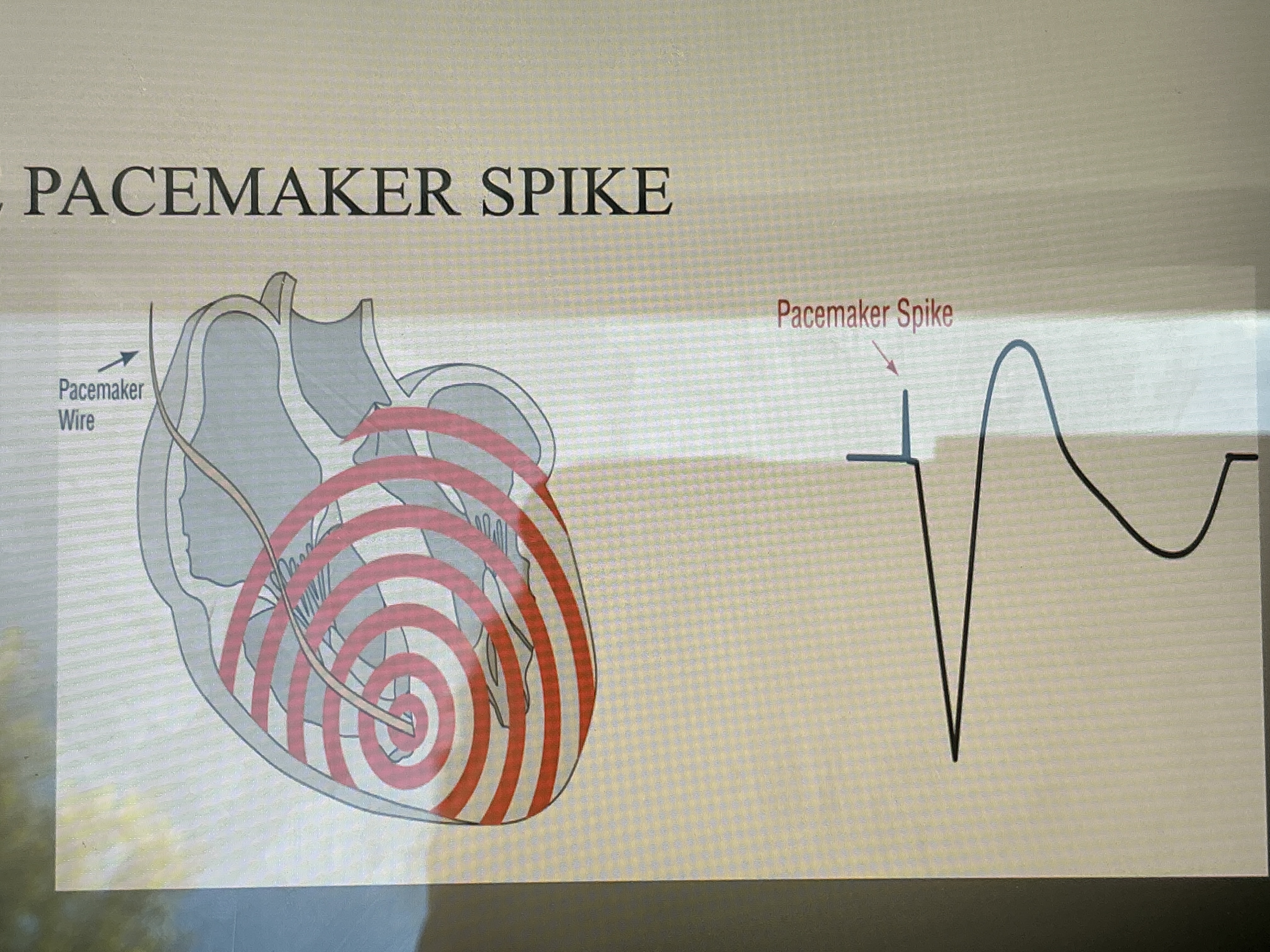 <p>Spike right before P wave</p>