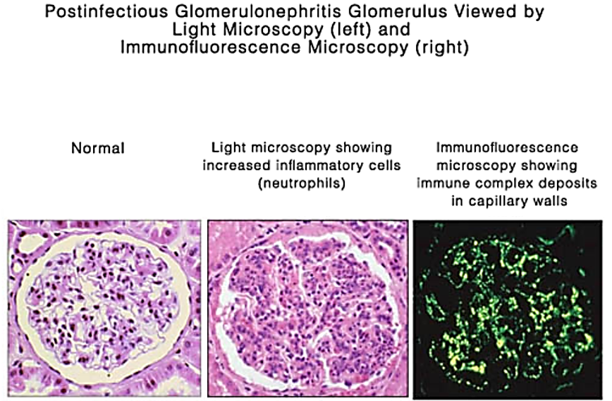 <p>TYPE 3 HYPERSENSITIVITY</p><p>streptococcal cell wall antigen may plant itself into glomerular membrane</p>