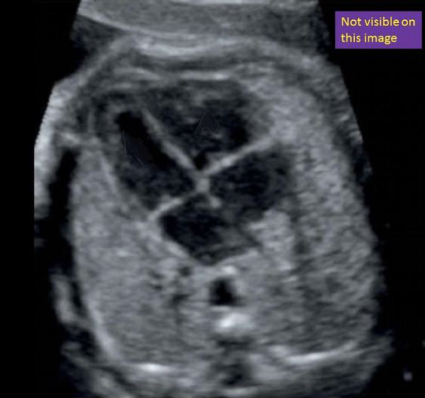 <p>where is the left ventricle </p><p>a) top left</p><p>b) top right</p><p>c) bottom left</p><p>d) bottom right</p>