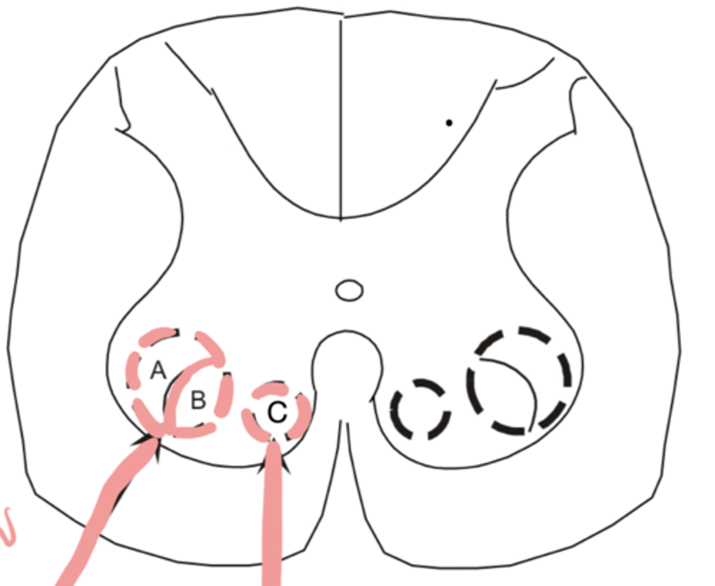 <p>An injury or damage to C would present as</p>