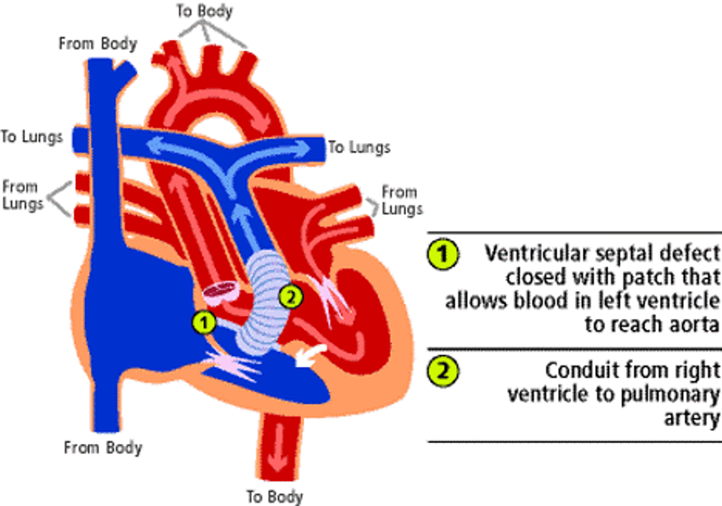 <p>Correction of transposition of great arteries</p><p>Aorta is rerouted internally to LV across VSD and pulmonary artery is attached to RV externally</p>