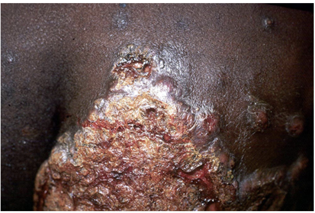<p>Presentation for Blastomycosis</p>