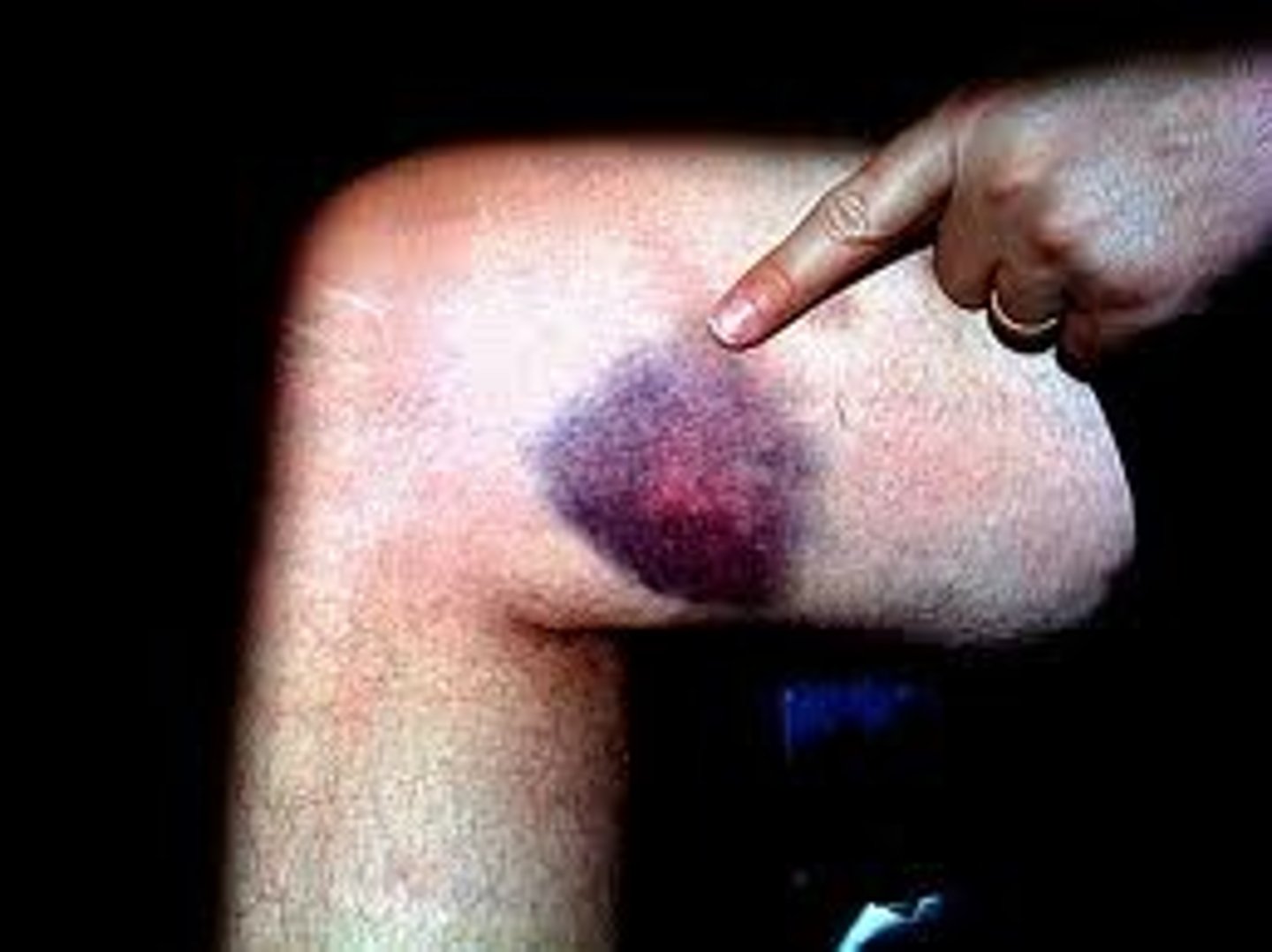 <p>moretones, contusiones, cardenales, magulladuras, hematomas, golpes corporales</p>