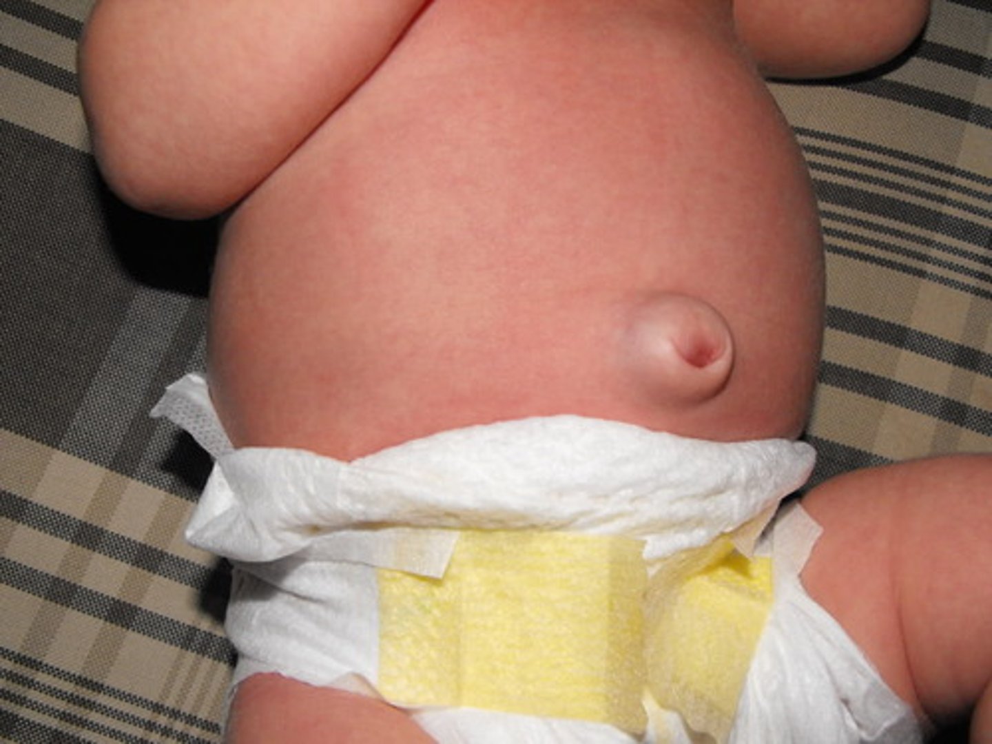 <p>protrusion of the intestine through a weakness in the abdominal wall around the umbilicus (navel)</p>