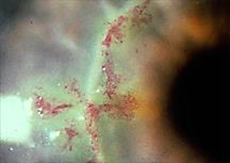 <p>Which Herpes variant is this?</p>