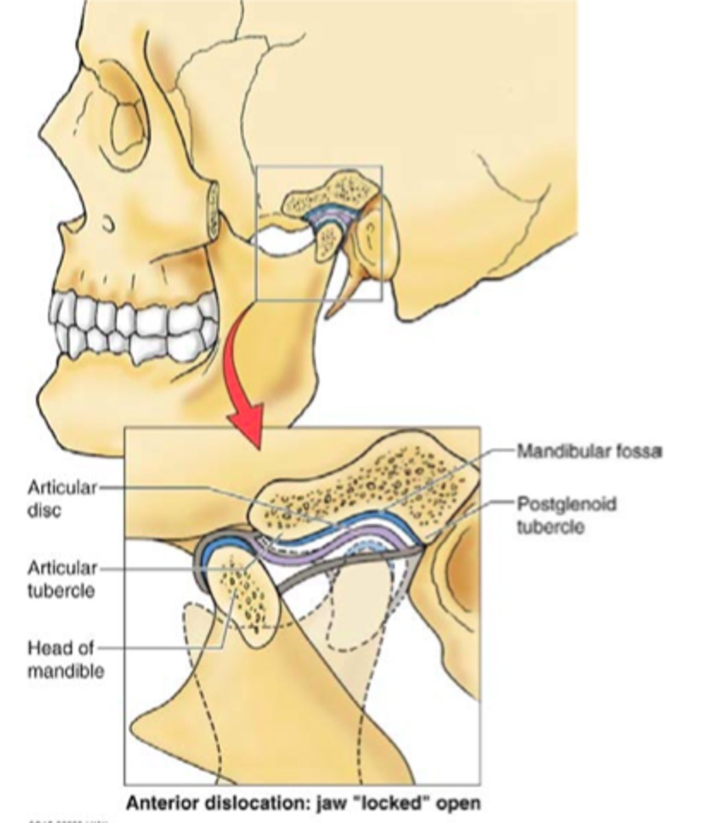 <p>refers to the case where the heads of the mandible and their articular discs slide anteriorly past the articular tubercle of the temporal bone</p>