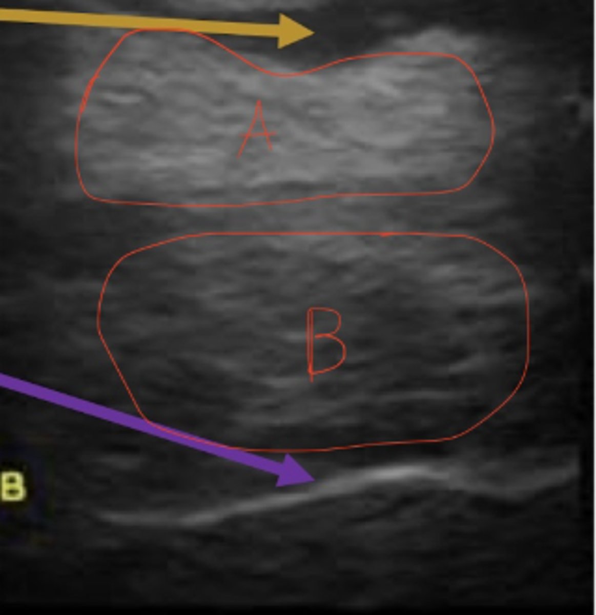<p>How does A relate to B in echogenicity?</p>