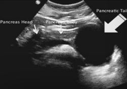 <p><span style="color: yellow;">Most common cystic lesion</span> of the pancreas</p><p>Fluid-filled loculus with <span style="color: yellow;">no epithelial lining</span></p><p>Located outside the pancreas often in <span style="color: yellow;">lesser sac</span></p><p>Pancreatic tissue is damaged and leaks enzymes and body fluid to form a cyst</p><p>Often occurs in the <span style="color: yellow;">tail</span></p>