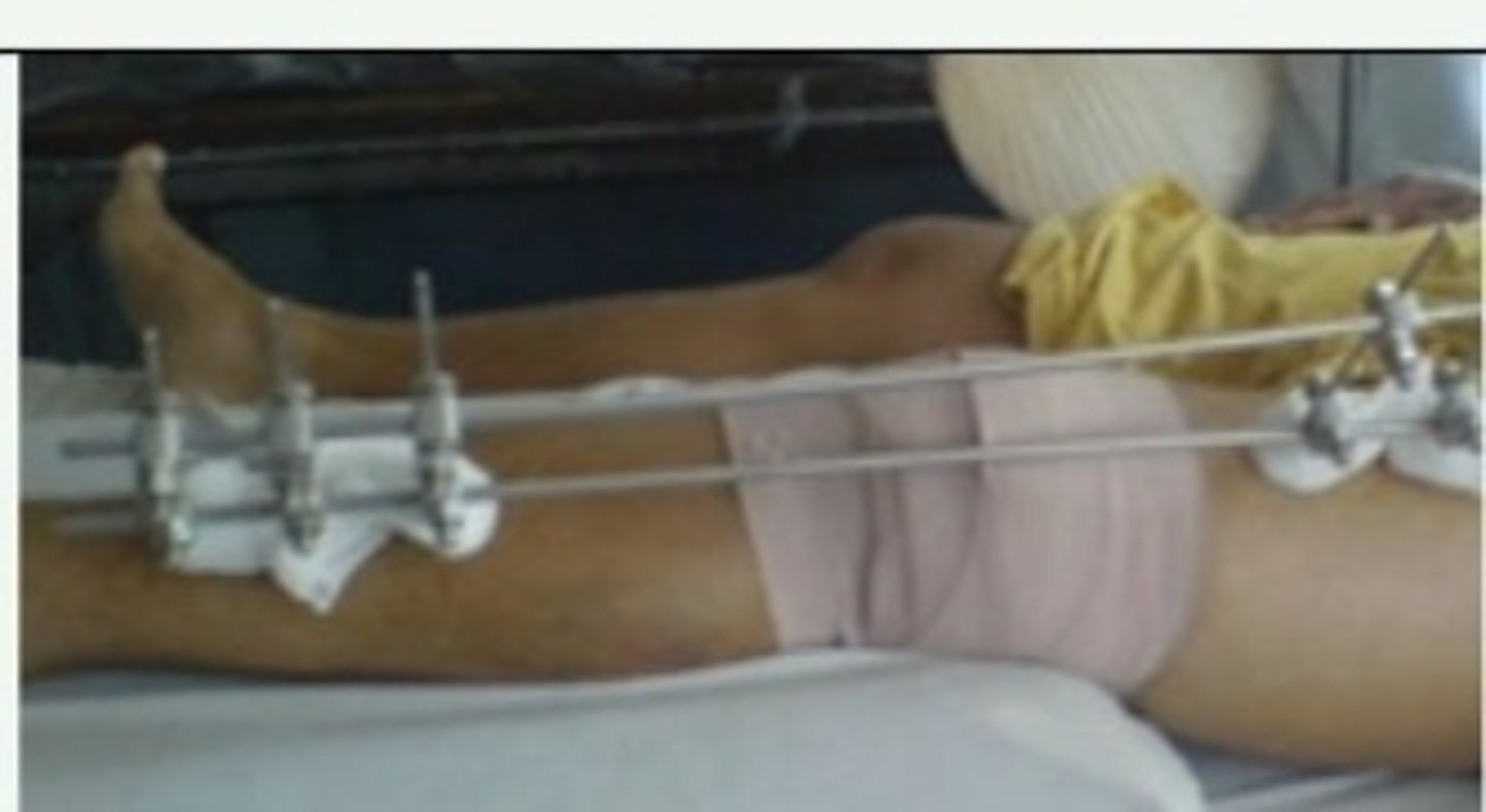 <p>fracture of femur extended to tibia</p>