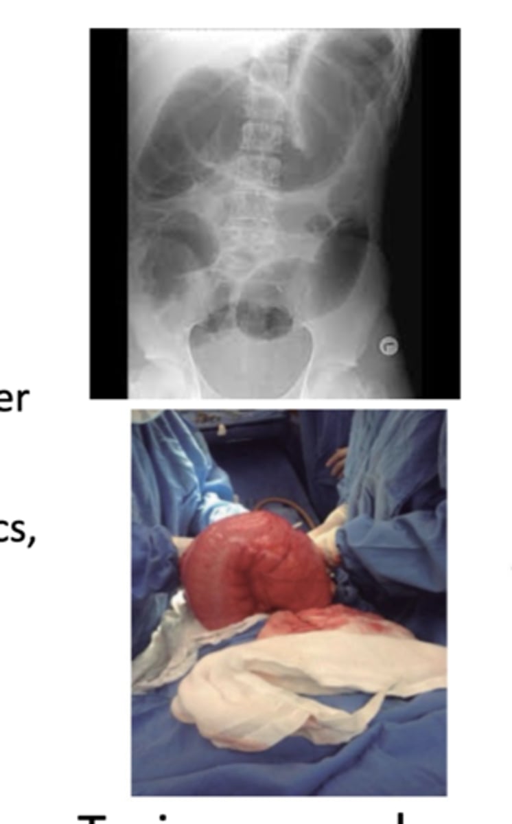 <p>-relapse --&gt; may be a role for probiotics &amp; fecal transplant</p><p>-toxic megacolon</p>
