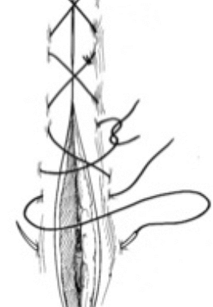 <p>appositional, too much tension will cause tissue to invert, faster than simple interrupted, gives a strong closure</p>