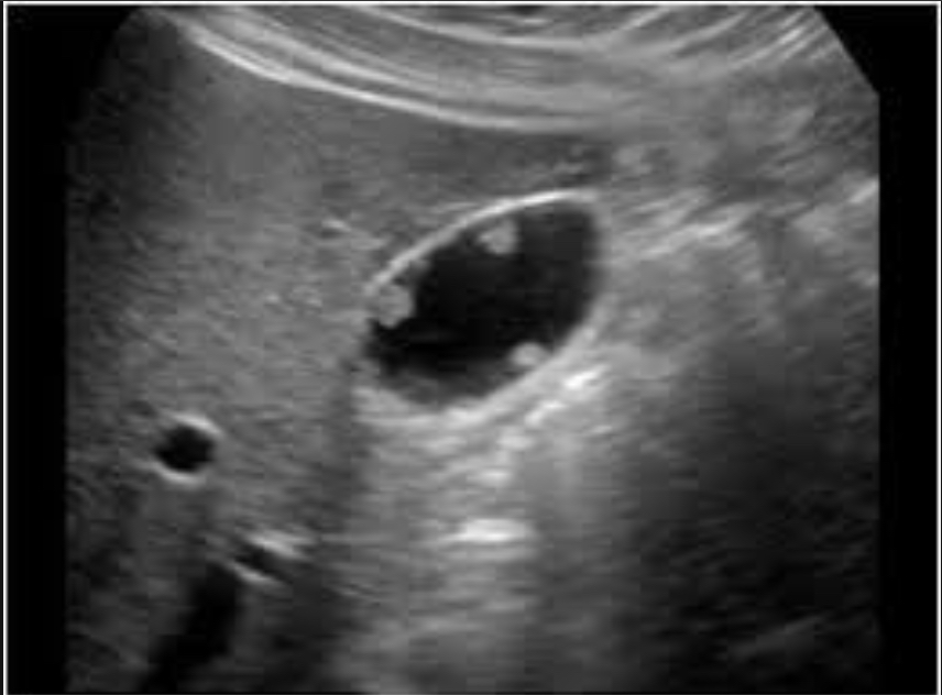 <p>Most common GB polyp type; lipid-laden macrophages </p><p>Small, multiple Echogenic polyps; non-shadowing, non-mobile; often &lt;10mm </p>