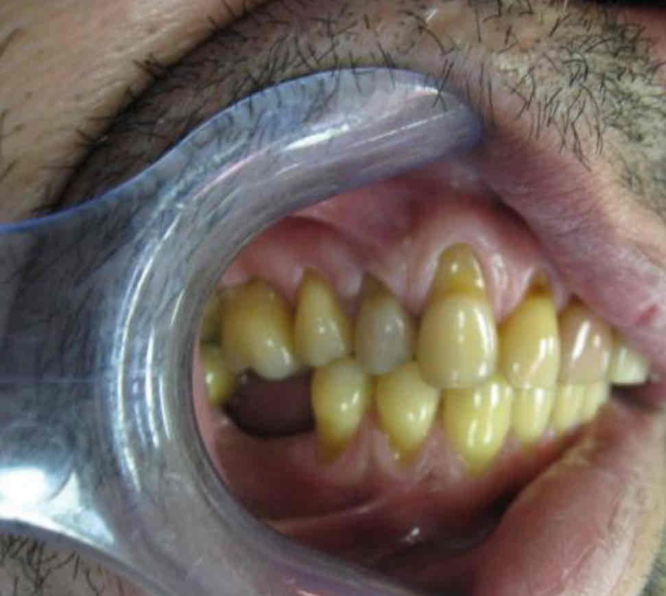 <ul><li><p>root of canine exposed </p></li><li><p>patient has periodontal disease</p></li><li><p>patient is an aggressive tooth brusher (abrasion) </p></li></ul>