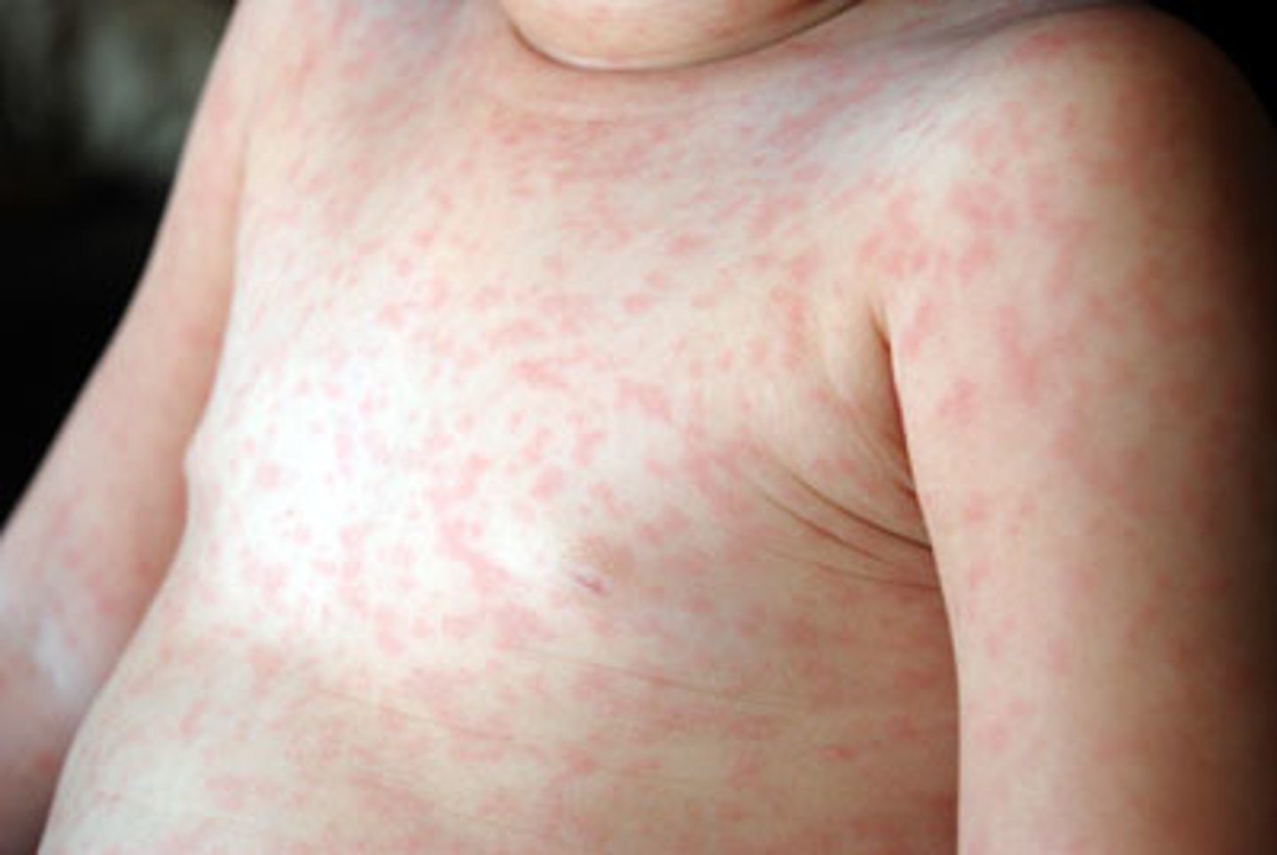 <p>High fever first, then pink spotted rash on chest, febrile seizures</p><p>Caused by HHV 6</p><p>- no vaccine</p><p>- no long term effects</p><p>- not contagious</p>