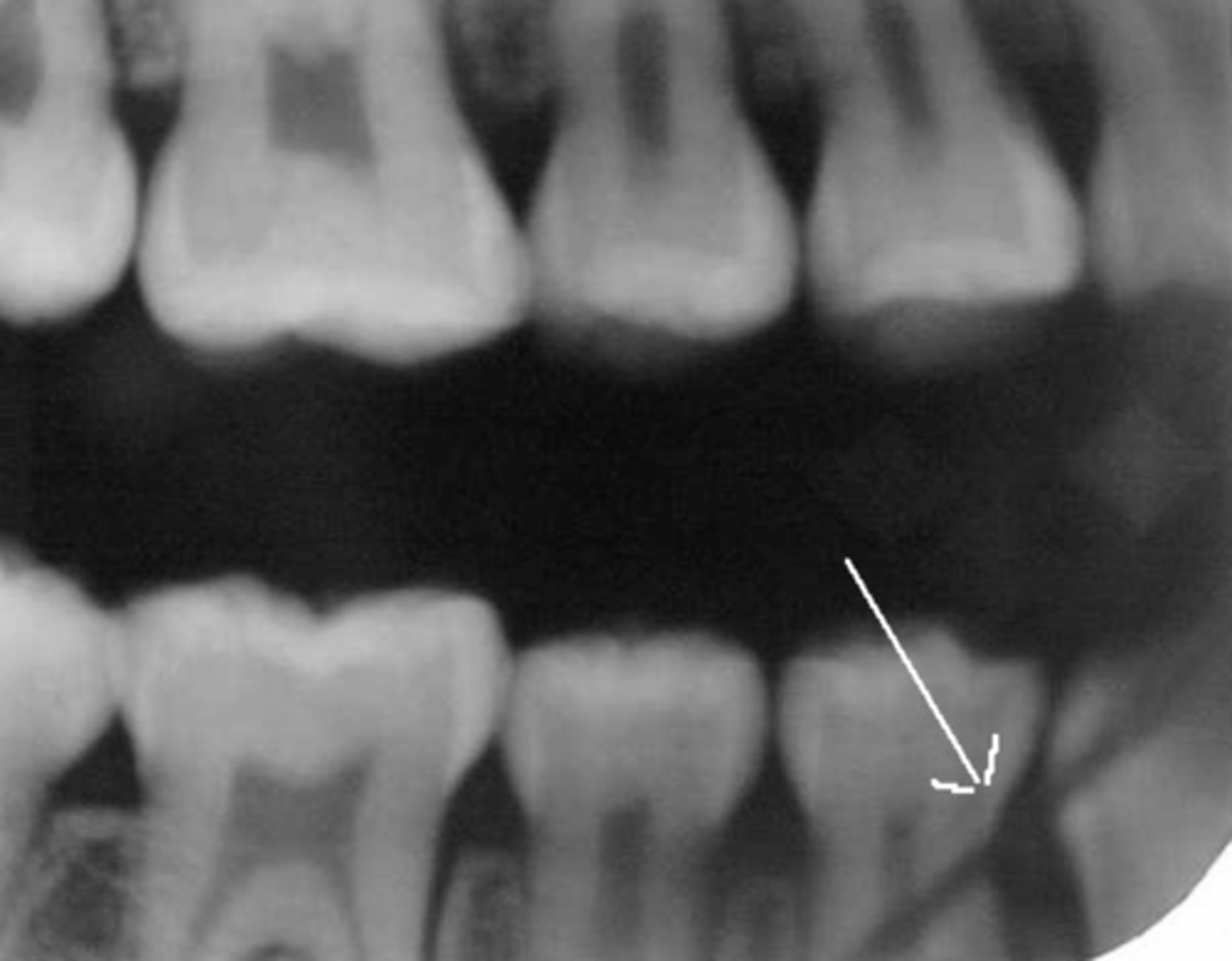 <p>-Bending the film or excessive pressure to the film emulsion can cause the emulsion to crack</p>