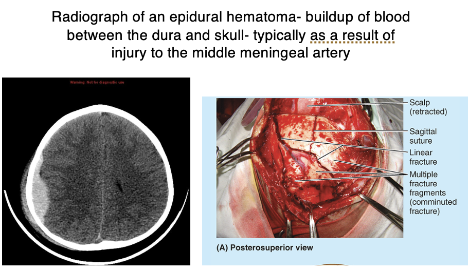 <p>Epidural hematoma</p>