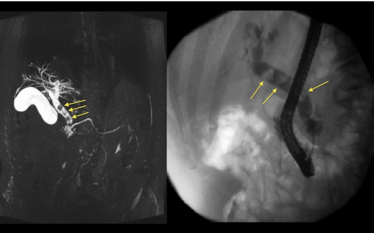 <p><strong>gallstone in common bile duct → obstruction of biliary flow → increased intraluminal pressure → </strong><span style="color: red"><strong>inflammation of gallbladder and pancreas</strong></span><br><em>risk factors; </em>older adults and patients without gallbladder</p><p>S/S:<span style="color: red"><strong> RUQ pain, Jaundice, pale stools, persistently dark urine</strong></span></p><p>Tx<strong>: </strong>analgesia: opioids, NSAIDs, Fluids and antiemetics if indicated <br>-<span style="color: blue"><strong>stone extraction and cholecystectomy (definitive)</strong></span><strong> </strong><br><strong>ERCP: </strong>minimally invasive stone extraction <br><strong>MRCP</strong>: noninvasive imaging <br><em>gastroenterology and/or general surgery consult</em></p>