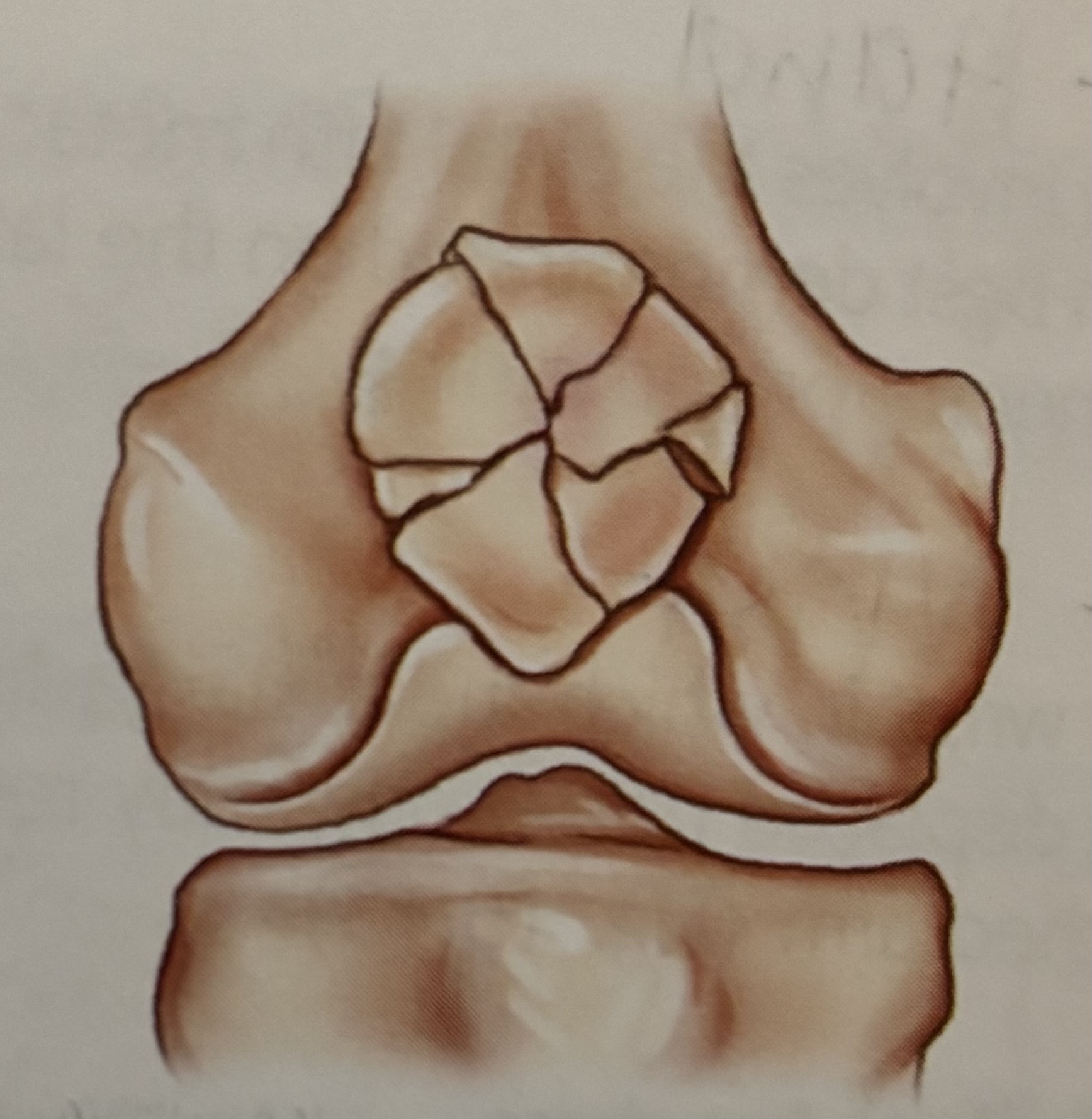 <p>What type of fracture is this?</p>