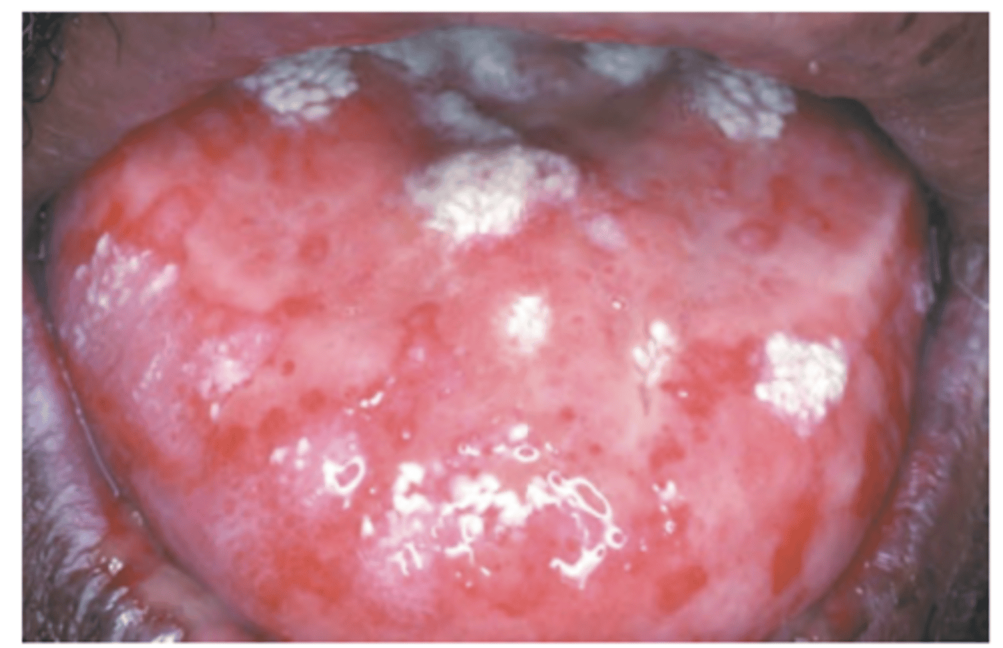 <p>Hint: Begins with target lesions on extremities</p>