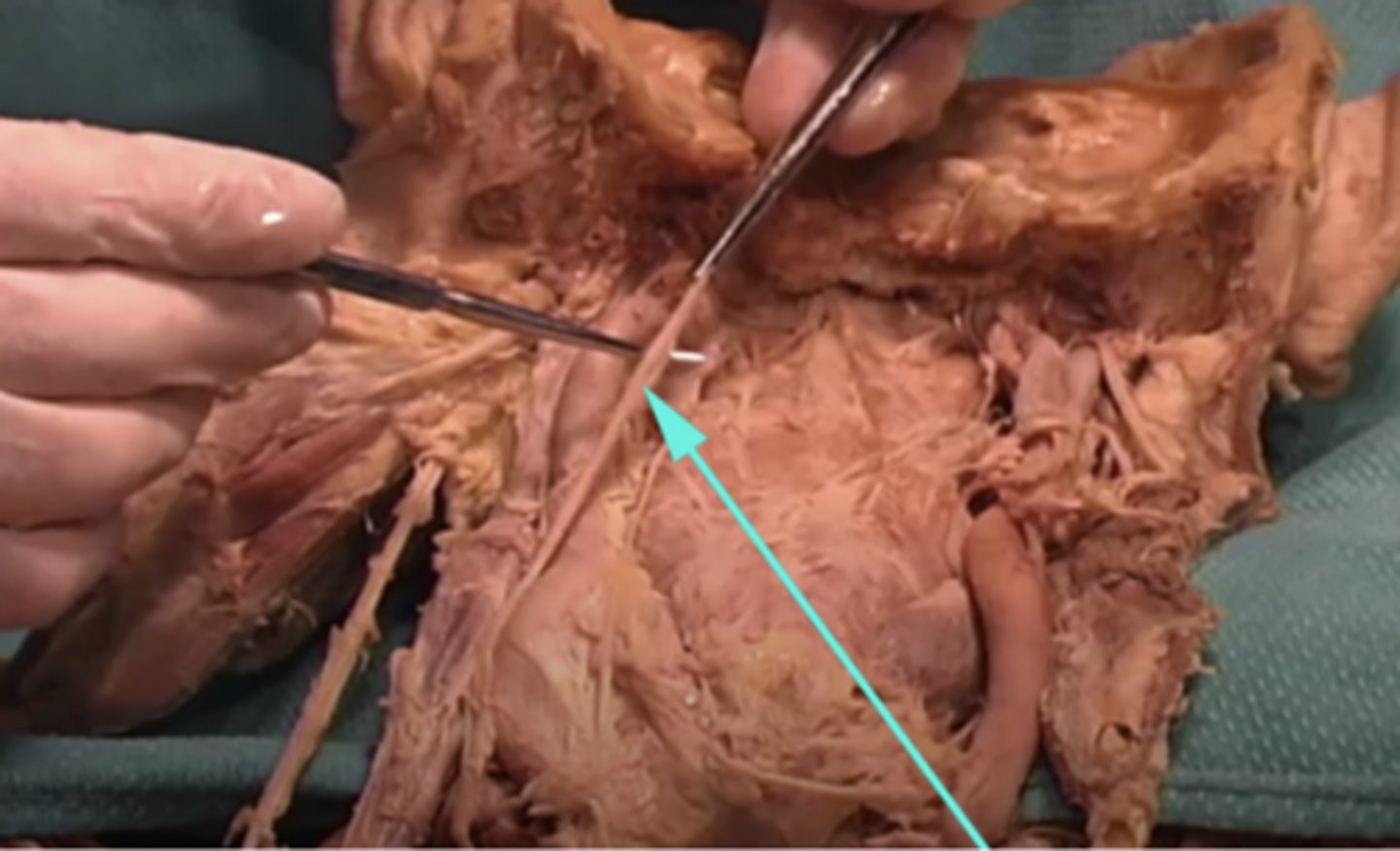 <p>What is the name of the structure as indicated by the arrow?</p><p>-pectoralis major</p><p>-pterygoideus</p><p>-vagus nerve</p><p>-Cranial nerve IX (9)</p>