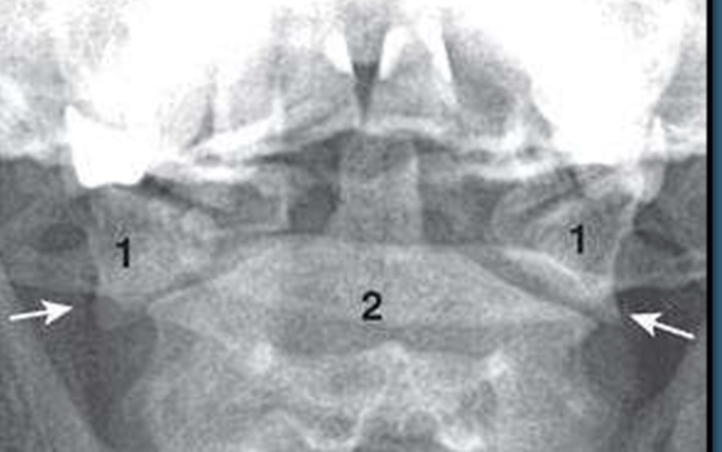 <p>What type of fracture is this?</p>