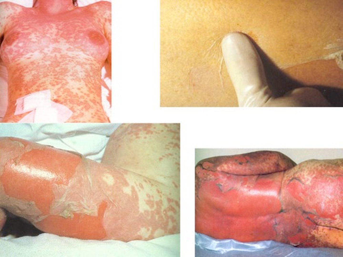 <p>This type of drug rash has erythematous erosions mainly localized on the face, upper trunk, and hands with lesions that begin as flaccid blisters.</p>