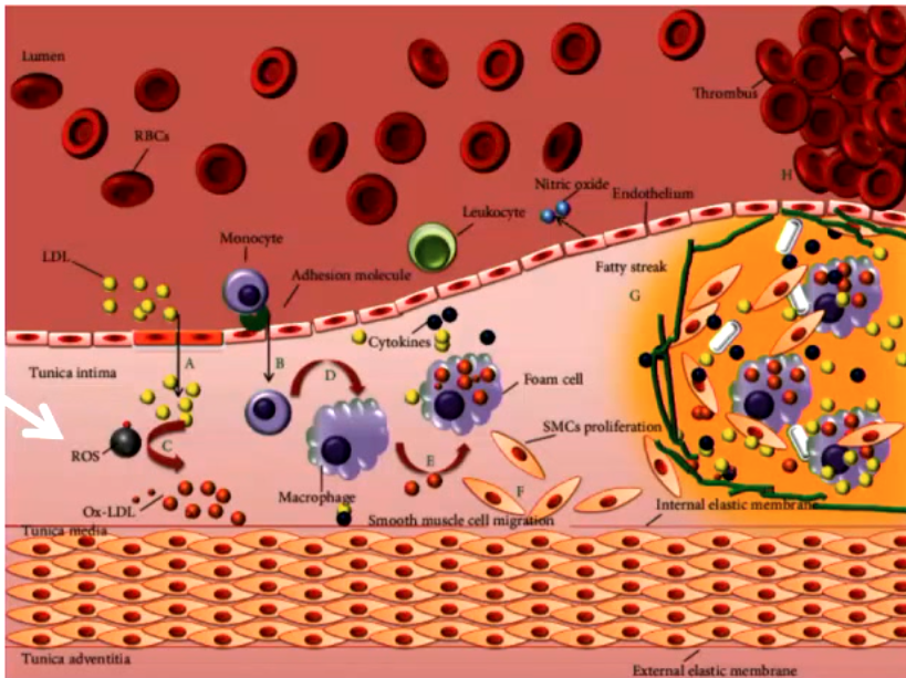 <p>atherogenesis (oxidation of LDL)</p><p>ischemia</p><p>alcoholism</p><p>regenerative disease (ALS)</p><p>acute renal failure</p><p>emphysema</p>
