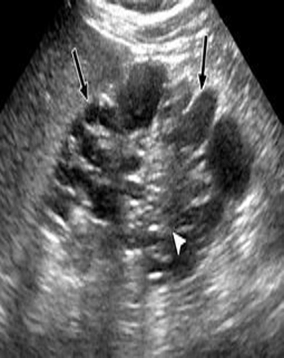 <p>dialysis</p>