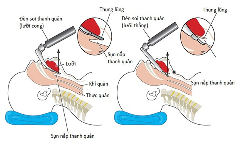 <p><strong>Để tiếp cận khí quản trong phương pháp mở khí quản ra da, người ta thường đi vào tam giác cổ nào sau đây?</strong></p><p>A. Tam giác cơ</p><p>B. Tam giác cảnh</p><p>C. Tam giác dưới đòn</p><p>D. Tam giác dưới hàm</p>