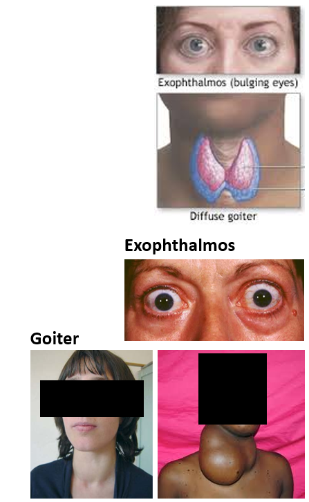 <ul><li><p>Excessive TH</p></li><li><p><strong>Grave’s disease: autoimmune disease caused antibody that mimics TSH, leading to overproduction of TH (most common)</strong></p></li><li><p>Anterior pituitary adenoma (tumor): secerets excess TSH (rare)</p></li><li><p>Thyroid tumor/cancer: secretes excess TSH (rare)</p></li><li><p>Symptoms:</p><ul><li><p>increased metabolic rate, high body temp</p></li><li><p>weight loss, increased appetite</p></li><li><p>weak skeletal muscles with tremors</p></li><li><p>diarrhea</p></li><li><p>protruding eyes (exophthalmos)</p></li><li><p>hyperactivity, insomnia</p></li><li><p>almost always a goiter</p></li></ul></li></ul><p></p>