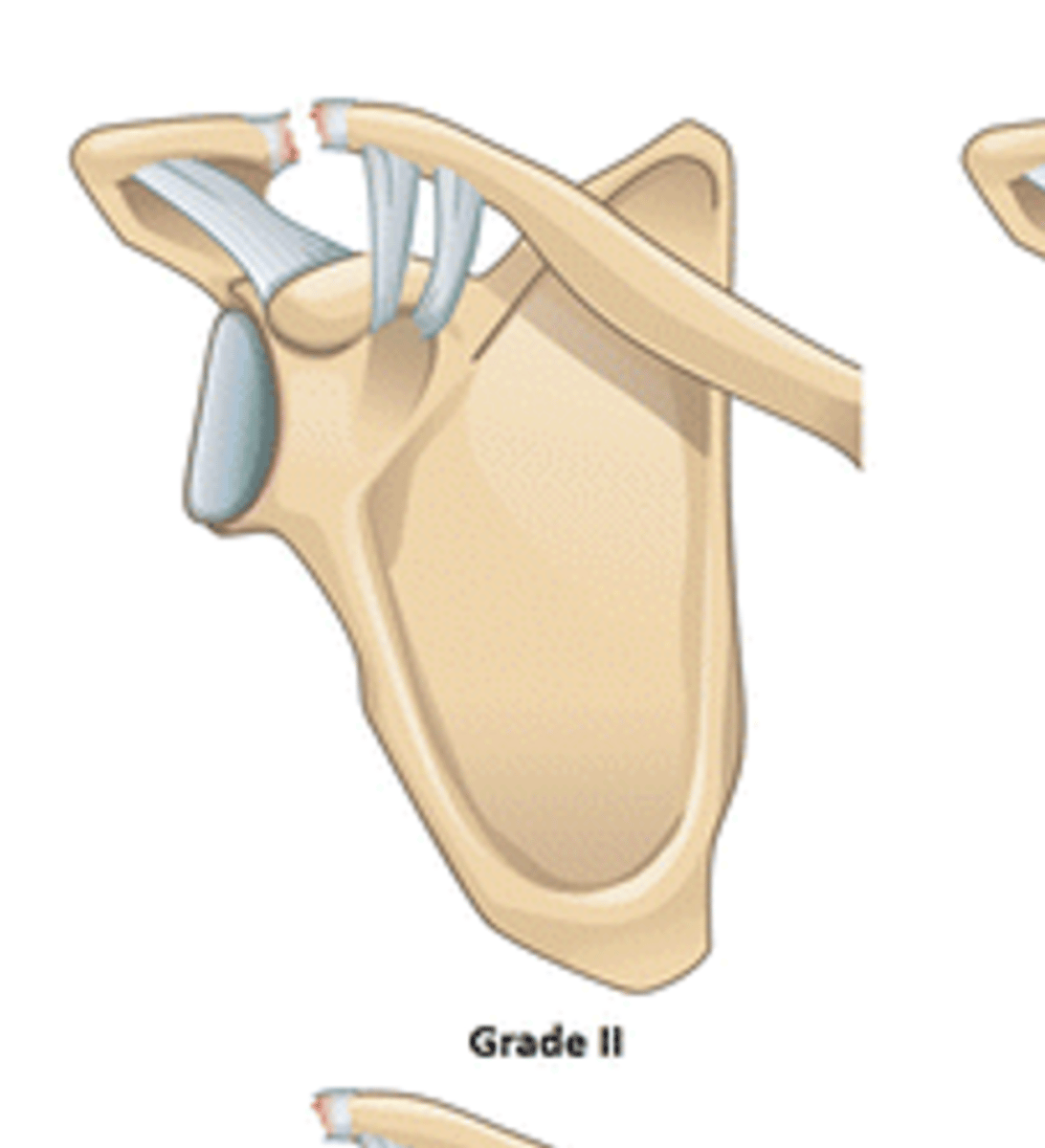 <p>According to the Rockwood Classification System, a grade II ACJ separation entails: __________. What is unique about it?</p>