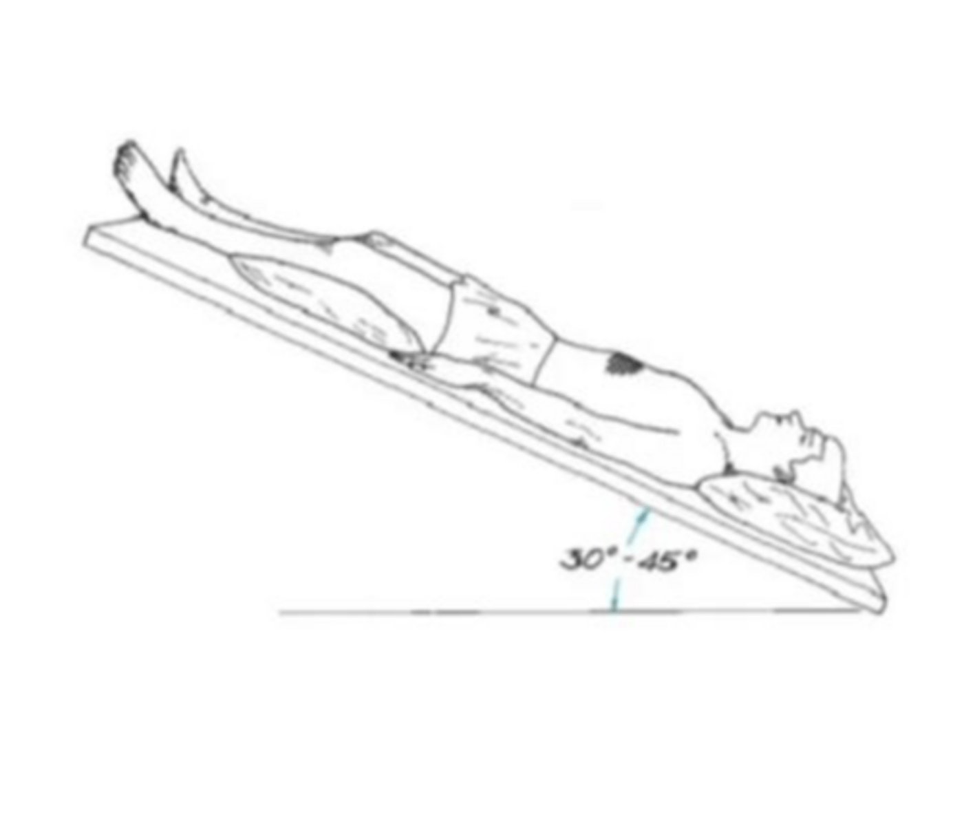 <p>patient lies supine, pillows under knees, in a 45 degree head-down position; percussion is applied bilaterally over the lower portion of the ribs</p>