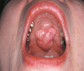 <p>is this a macule, papule, nodule, or lobule </p>
