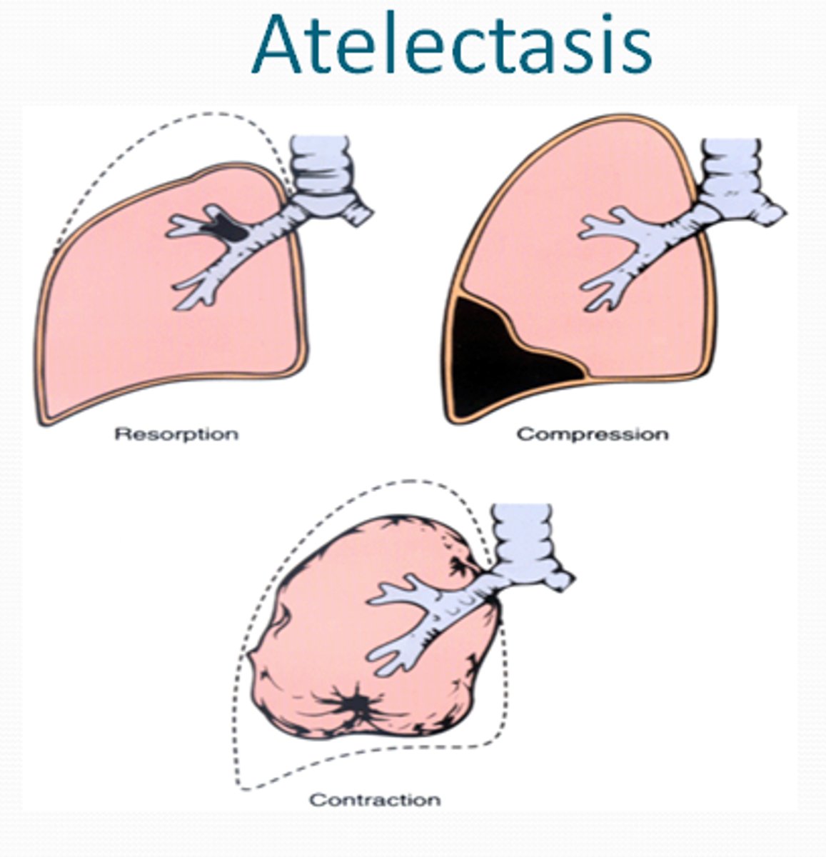 <p>Alveolar volume loss resulting in collapse of a portion of the lung</p><p>Causes:</p><p>• Airway obstruction - mucous plugging, tumor, foreign body, bronchial intubation</p><p>• Airway compression -hemothorax, lymphadenopathy, tumor</p><p>• Lung compression - pleural effusion, pneumothorax</p><p>• Hypoventilation - general anesthesia, opioids, obesity</p>