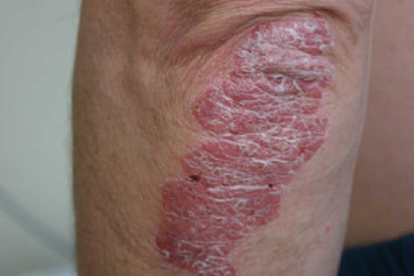<p>Plaque psoriasis</p>