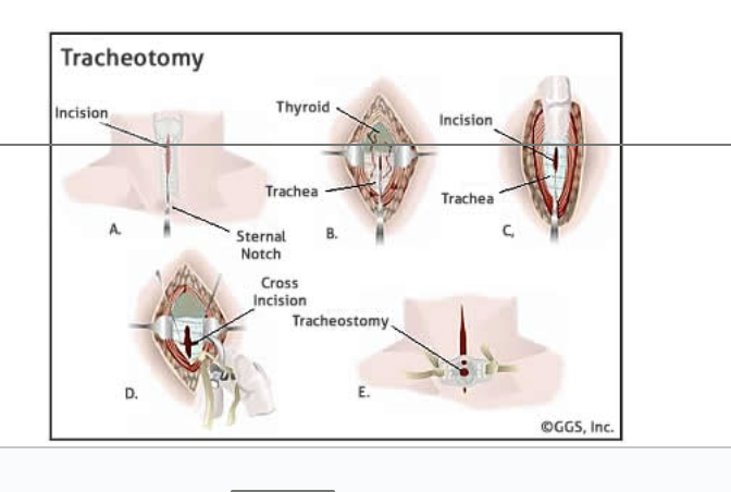 <p>procedure where one makes a temporary opening in the trachea and inserts a tube to allow airflow</p><ul><li><p>Prevents asphyxiation due to upper airway obstruction	</p></li><li><p>Inhaled air bypasses the nasal cavity and is hot humidified</p></li><li><p>If tube is left in for too long, it will dry out mucous membranes of the respiratory tract</p><ul><li><p>membrane will become encrusted and interfere with clearance of mucus from tract, promoting infection</p></li></ul></li></ul><p></p>