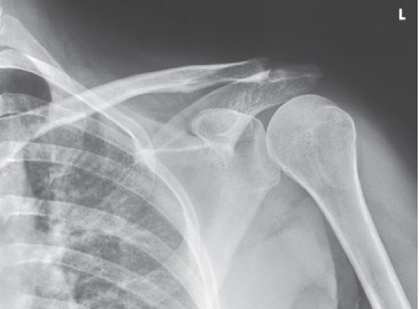 <p>- greater tubercle</p><p>- humeral head</p><p>- superior scapula, lateral half of clavicle,a nd proximal humerus</p>