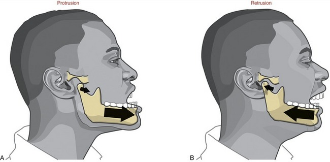 <p>Overdeveloped lower lip due causing lower teeth/jaw to be positioned further back. </p>