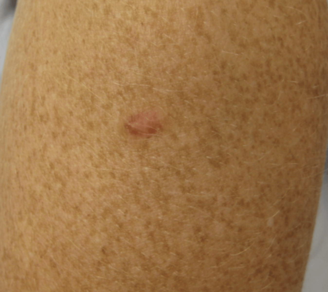 <p>Benign tumor of the skin</p><p>firm, hyperpigmented dome-shaped papule</p><p>If you pinch the sides it will dimple- "dimple sign"</p>