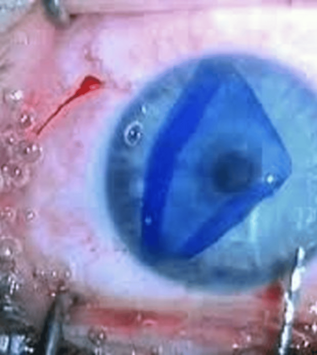 <p>What is a Descemet's membrane endothelial keratoplasty (DMEK)?</p>