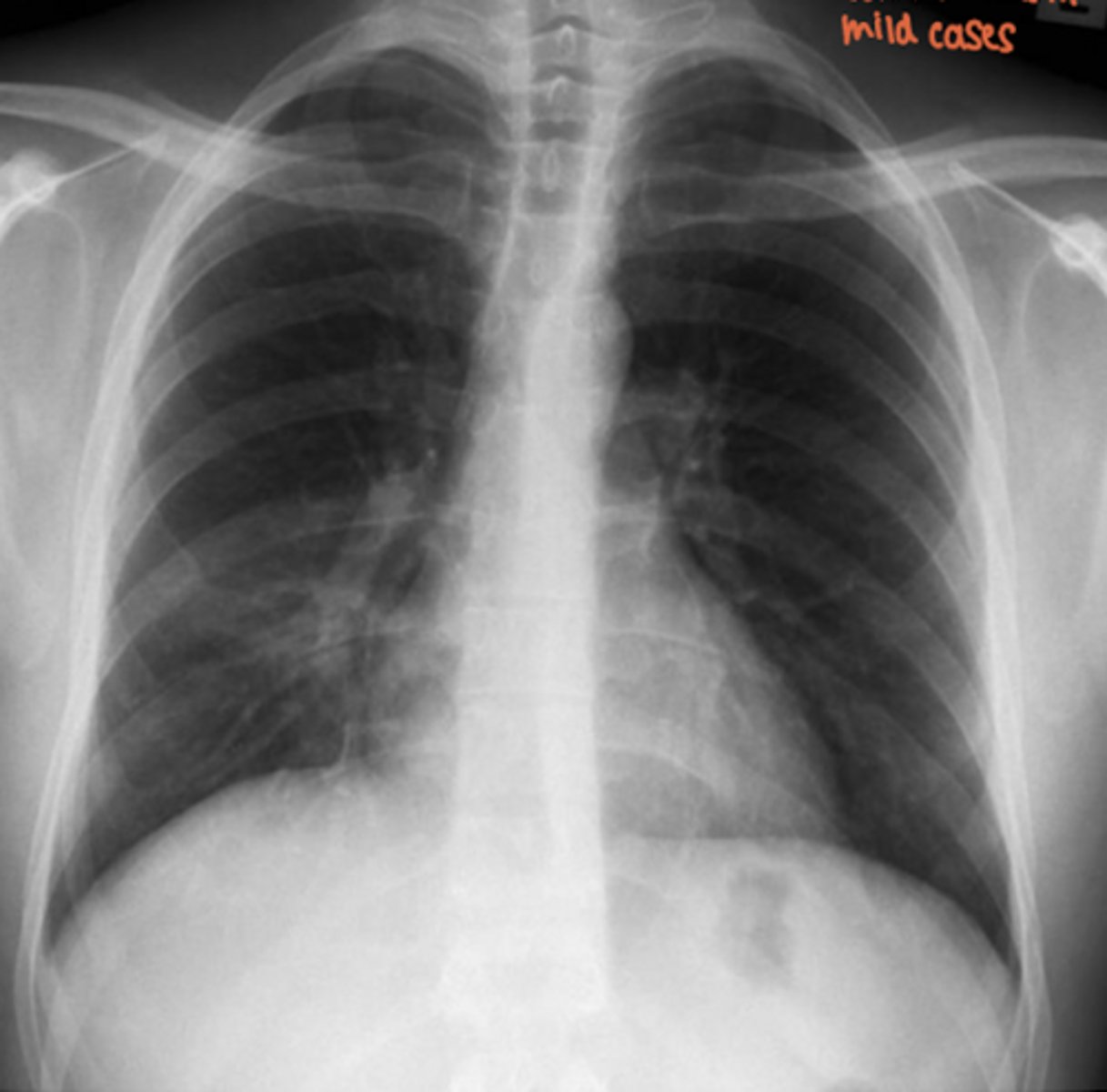 <p>What is this pattern of lung disease?</p>