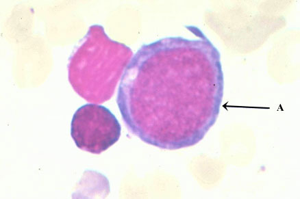 <ul><li><p>20-25 u</p></li><li><p>high N:C ratio</p></li><li><p>lacy chromatin </p></li><li><p>nucleoli</p></li><li><p>basophilic cytoplasm</p></li><li><p>no granules</p></li></ul><p></p>