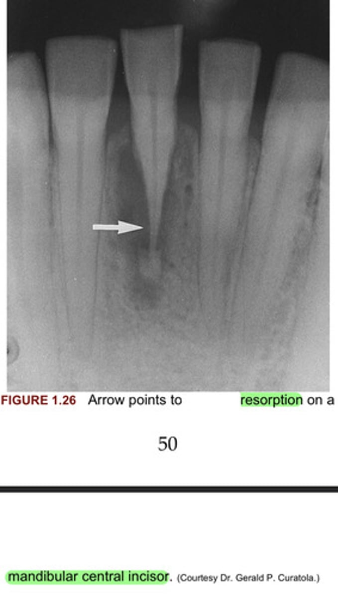 <p>In figure 1.26 the arrow points to what resorption on a mandibular central incisor?</p>