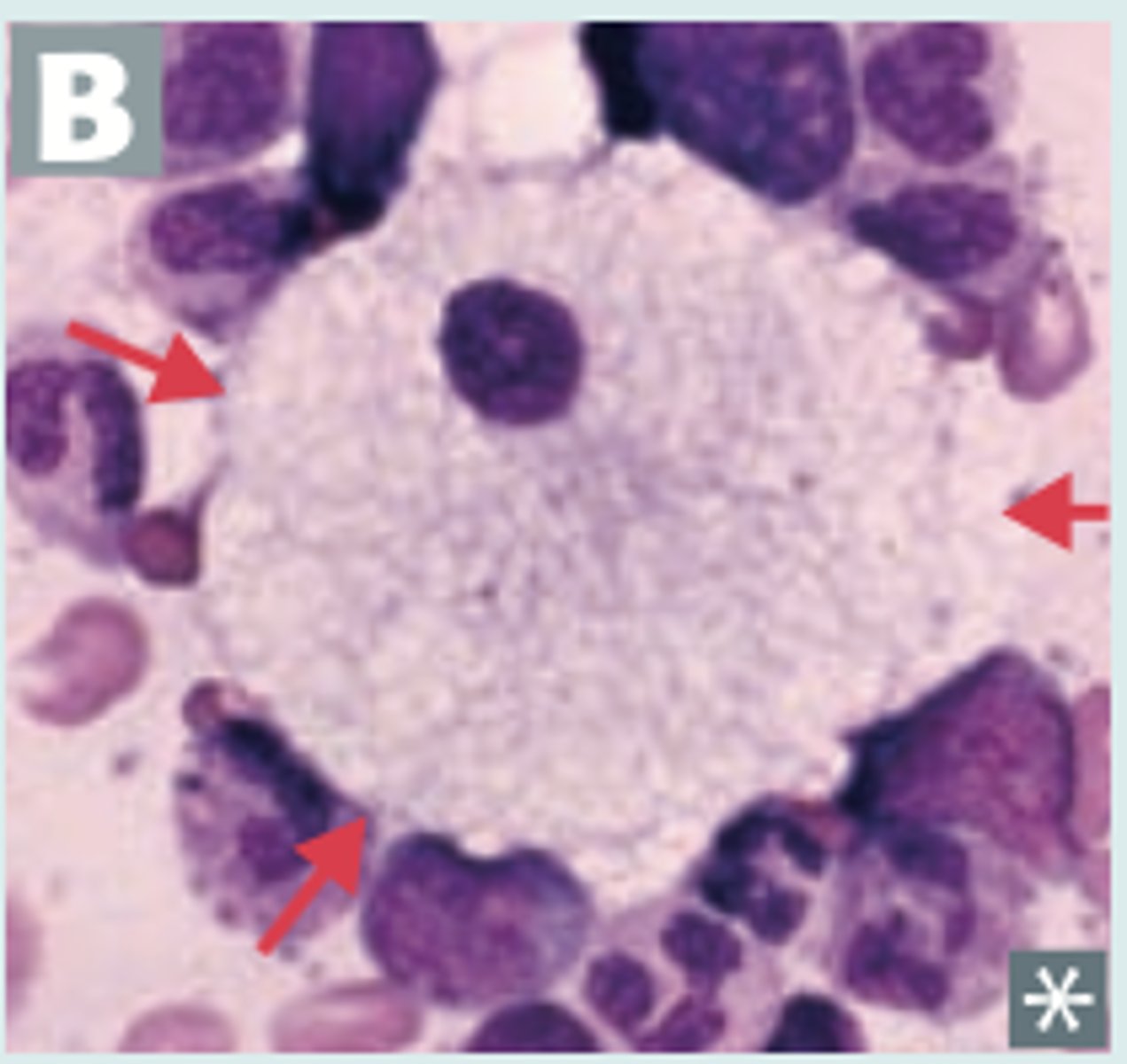 <p>Sphingomyelinase deficiency = increase sphingomyelin</p><p>RBC nuclei contain sphingomyelin</p>