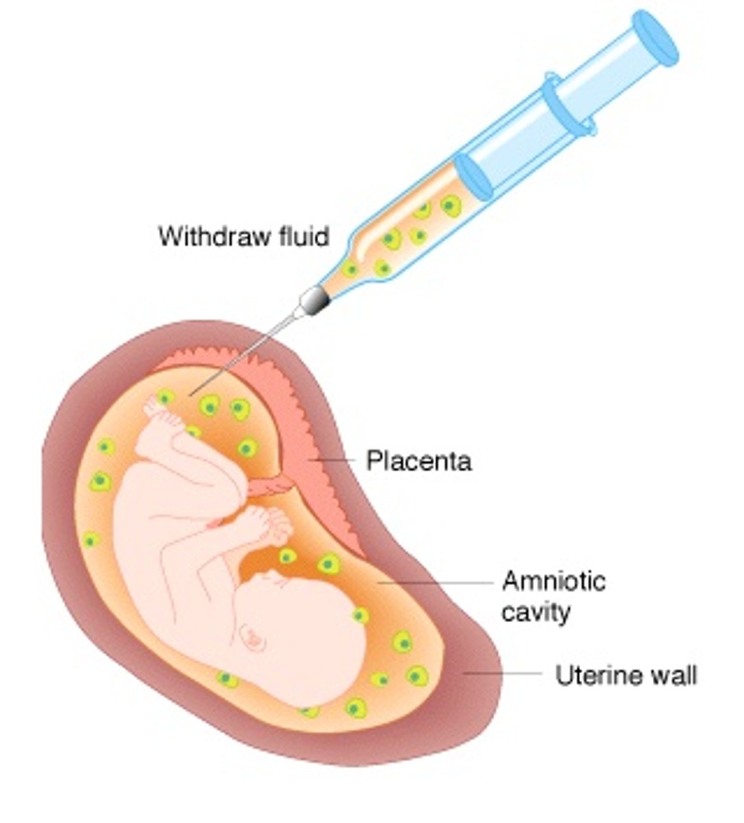 <p>A technique for determining genetic abnormalities in a fetus by the presence of certain chemicals or defective fetal cells in the amniotic fluid, obtained by aspiration from a needle inserted into the uterus</p>