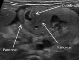 <p>The pancreas is wrapped around the duodenum. What can be assumed here?</p>
