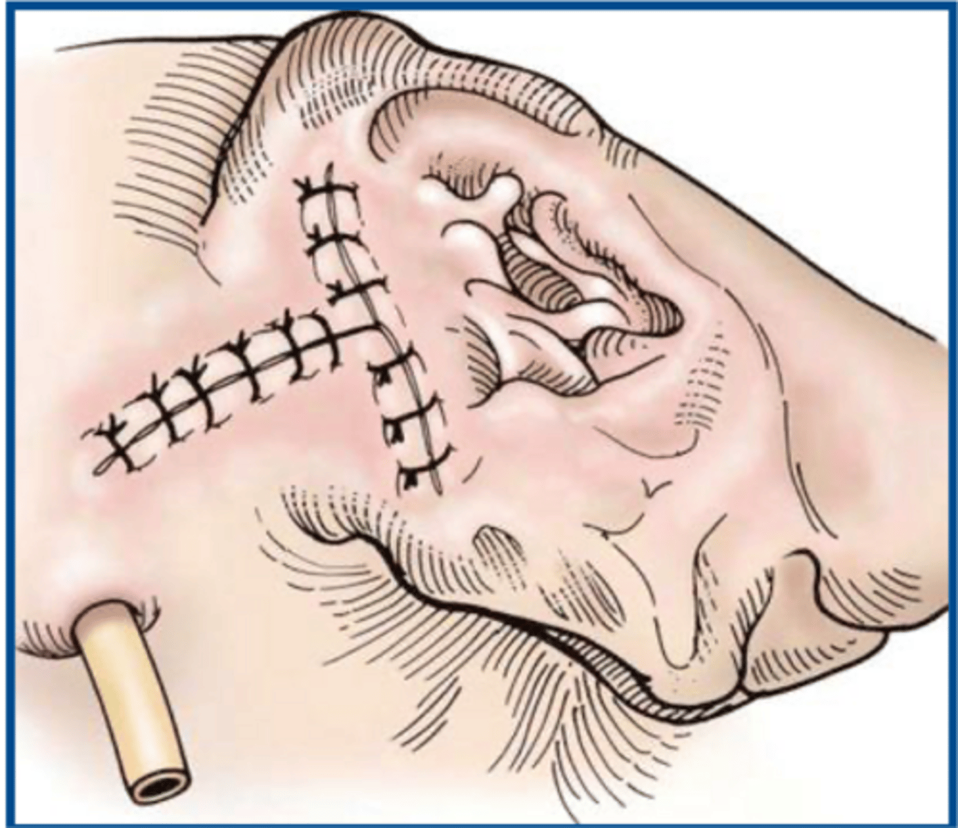<p>why must a bulla osteotomy (LBO) always be performed in conjunction with a TECA for otitis externa and media</p>