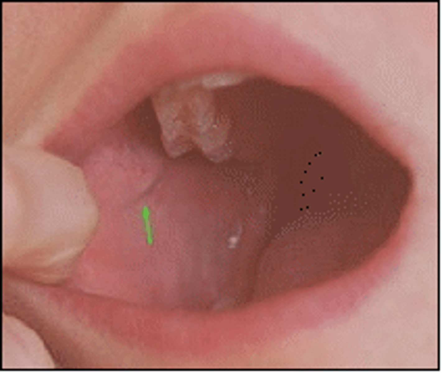 <p>parotid glands</p><p>-enters oral cavity through buccal mucosa opposite the upper second molar</p>