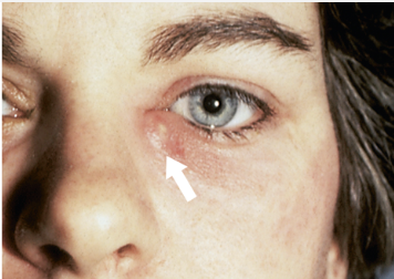 <p>Inflammation of the lacrimal sac. Caused by infection and blockage of sac and duct. </p>